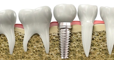 A digital image of a single tooth dental implant sitting along the lower arch of a patient’s mouth after they’ve undergone a dental implant procedure