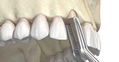 A digital image of a bone grafting procedure occurring in the upper arch of the mouth