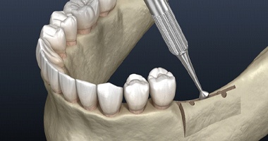 A digital image of a ridge expansion being performed using specialized dental instruments