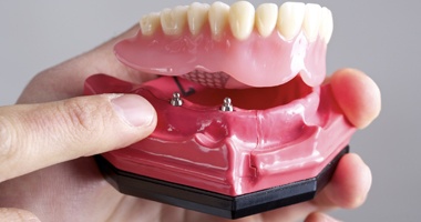 an implant supported denture