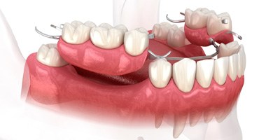 Illustration of partial dentures being placed on lower dental arch 