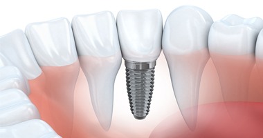 an image of a dental implant