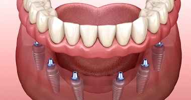 An image of implant dentures