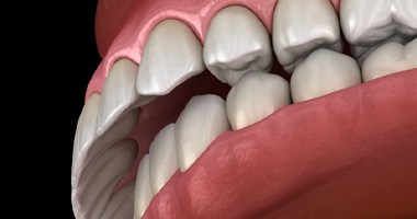 an animation showing overbite 