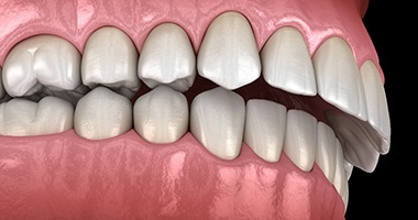 Digital illustration of overbite before braces