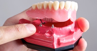 Image of an All-on-4 implant denture.
