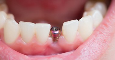 photo of a dental implant