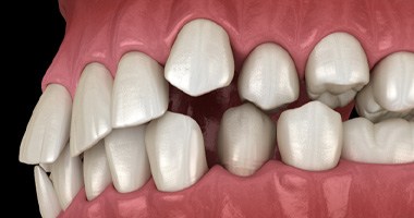 an animation of crowded teeth 