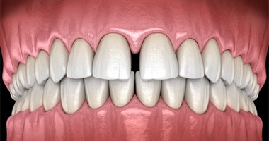 an animation showing gapped teeth 