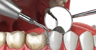A dental cleaning on the lower teeth