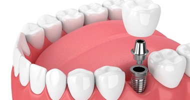 3D illustration of a dental implant in Medford