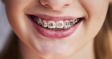 Closeup of traditional braces in Medford on smiling girl 