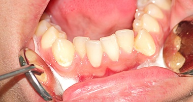 Closeup of crooked teeth before braces