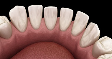 Digital illustration of gapped teeth before braces 
