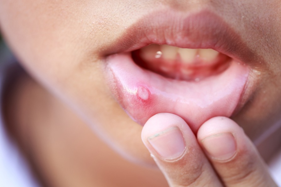 A canker sore being evaluated by an emergency dentist in Medford