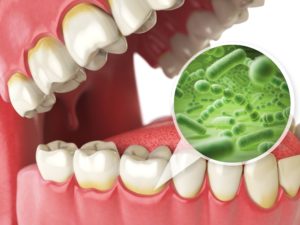 Model of gum disease from poor oral hygiene