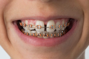 a close-up of a person’s mouth with braces
